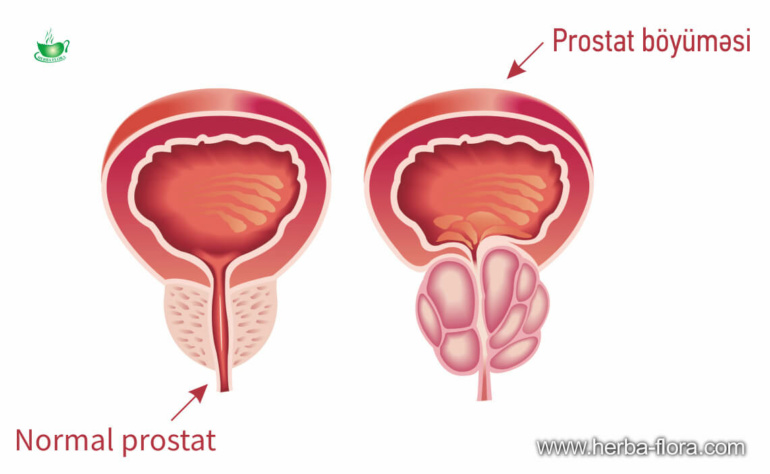Prostat vəzin hiperplaziyası
