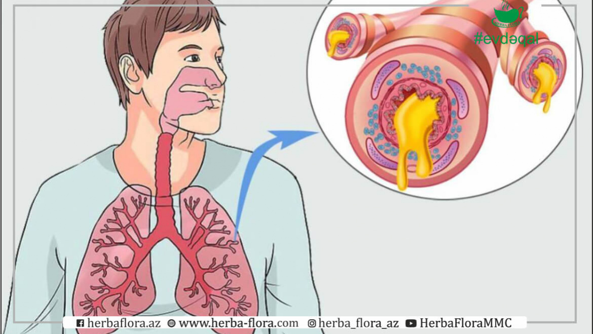 Allergik bronxit